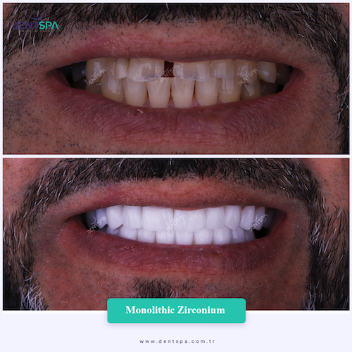 Couronnes Zircones — DentSpa Clinic