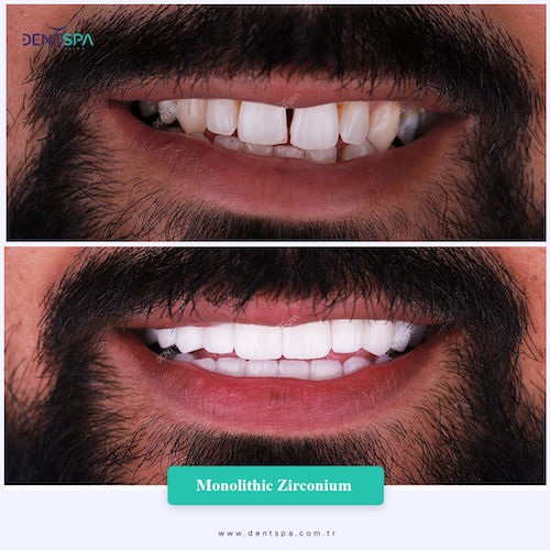 Couronnes Zircones — DentSpa Clinic