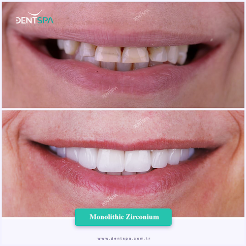Couronnes Zircones — DentSpa Clinic