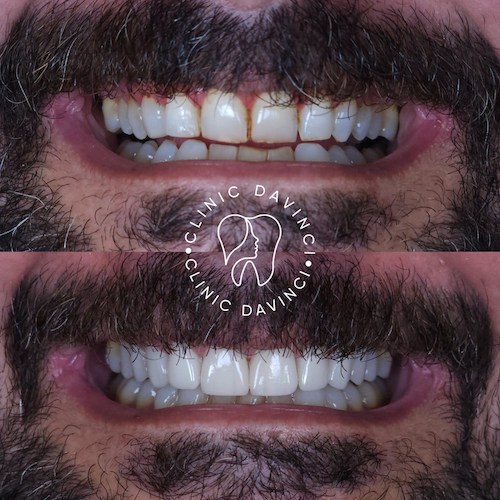 Facettes Dentaires — Clinique Davinci