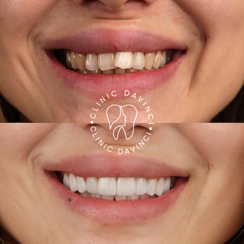 Facettes Dentaires — Clinique Davinci