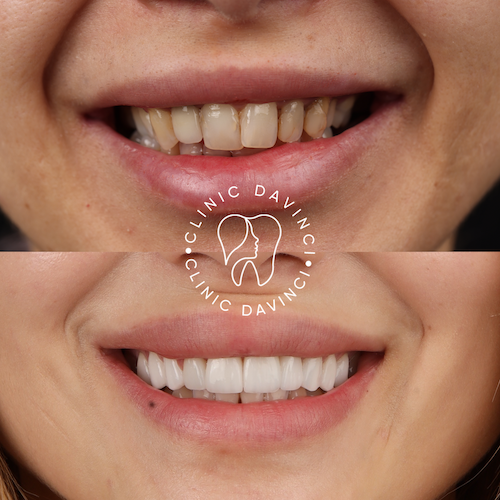 Facettes Dentaires — Clinique Davinci