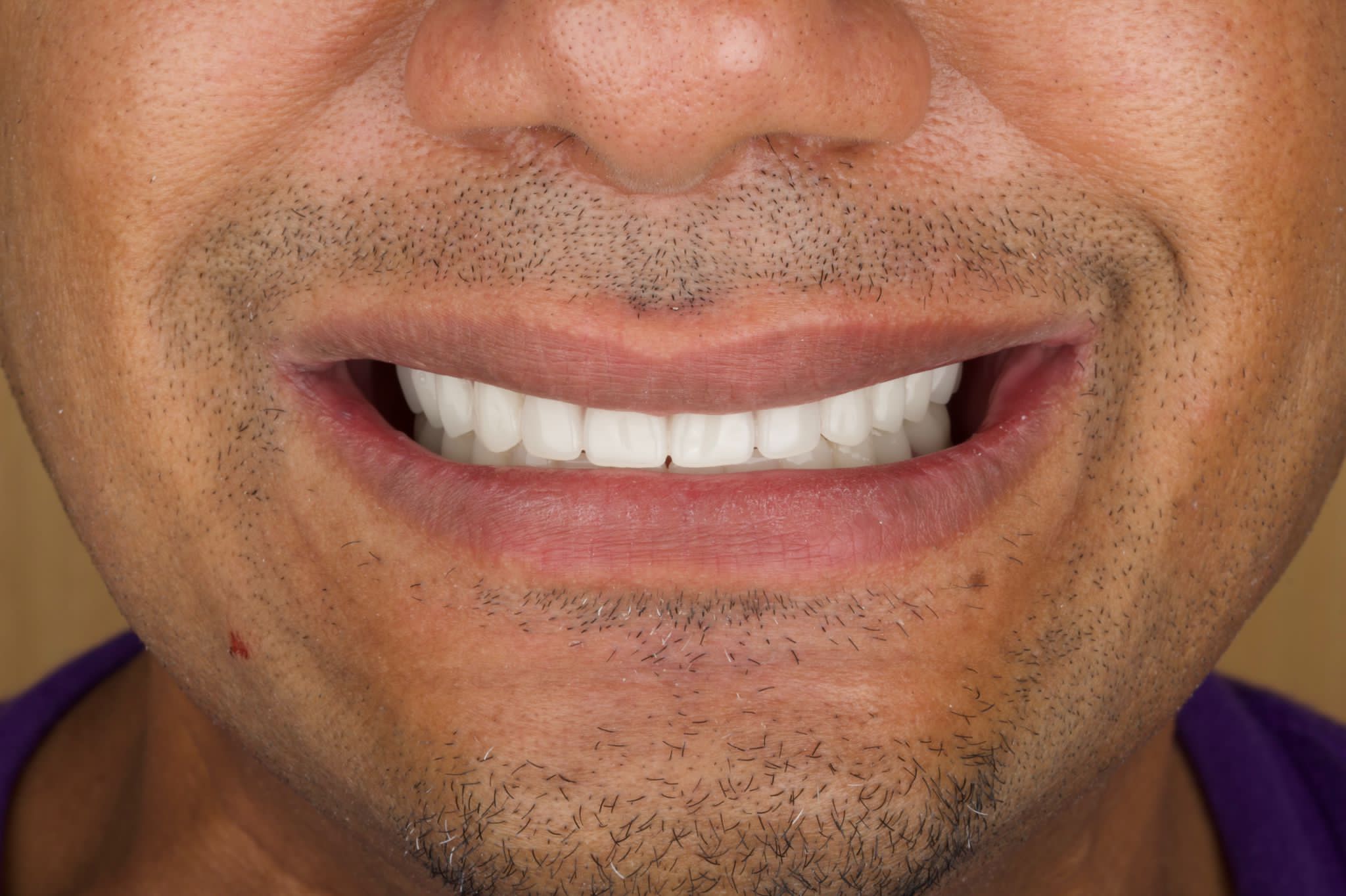 Implants Dentaires — Dentaglobal
