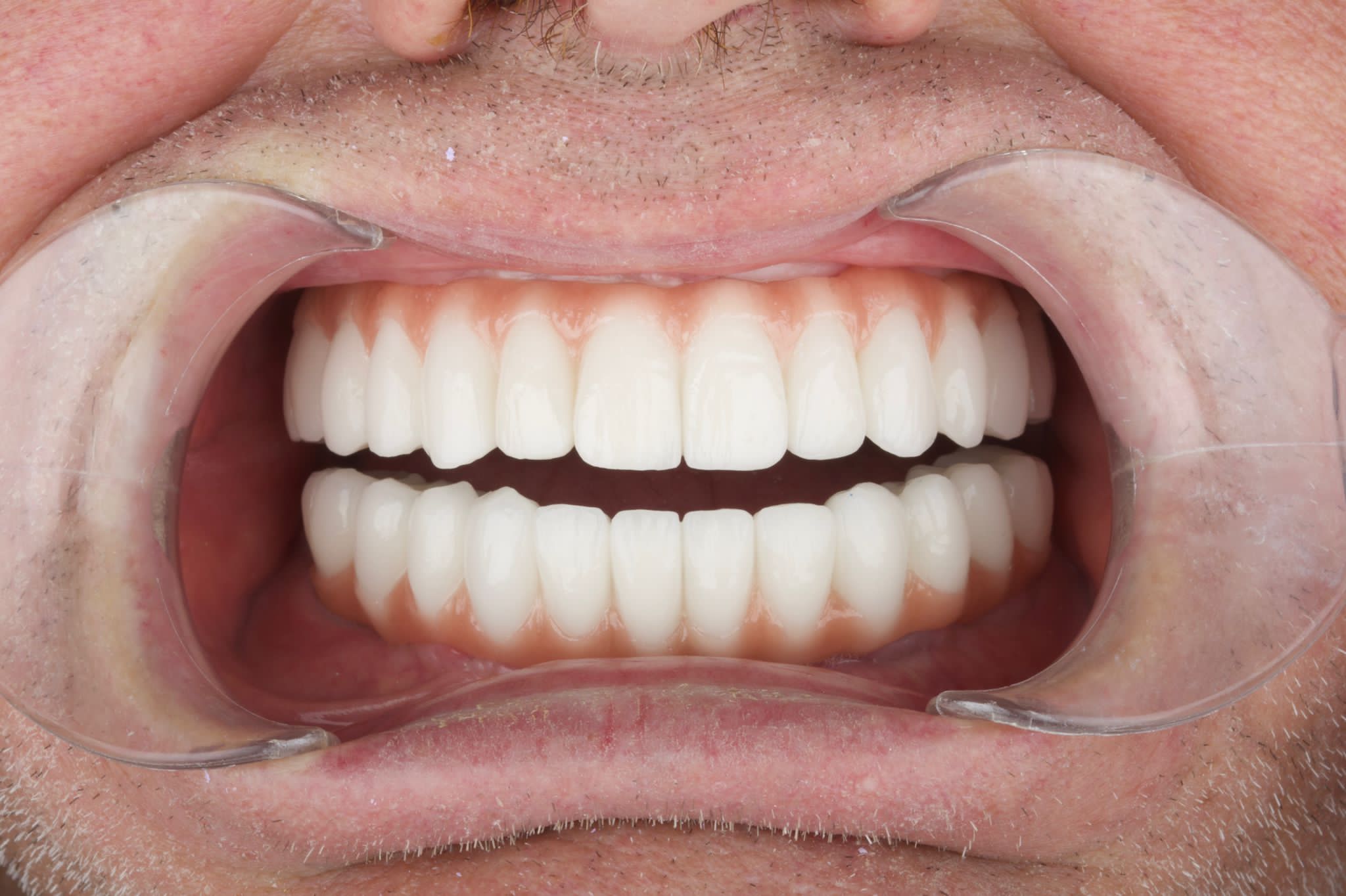 Implants Dentaires — Dentaglobal