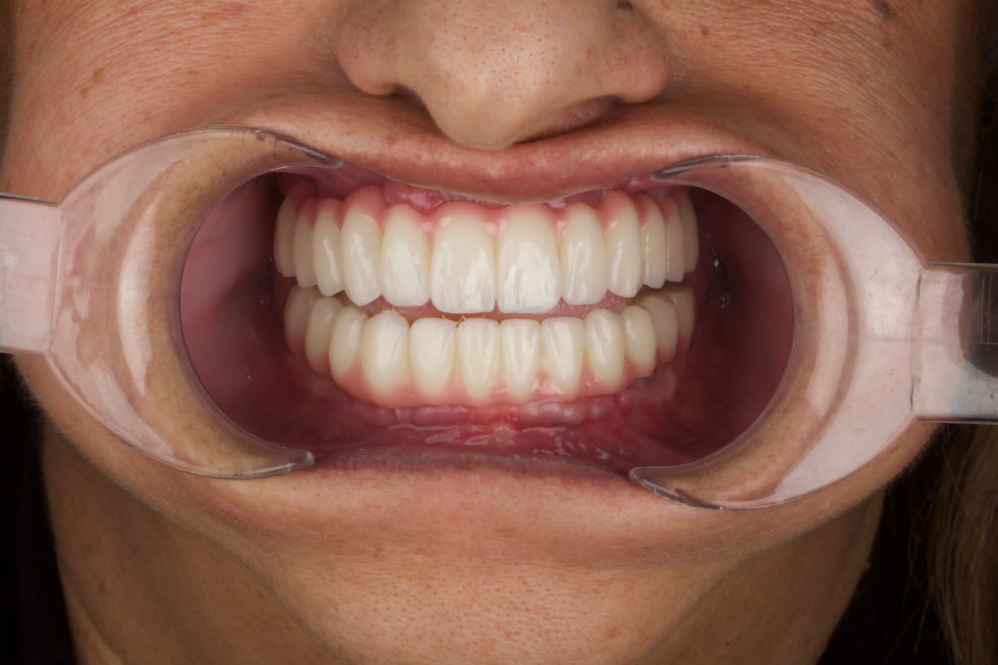 Implants Dentaires — Dentaglobal