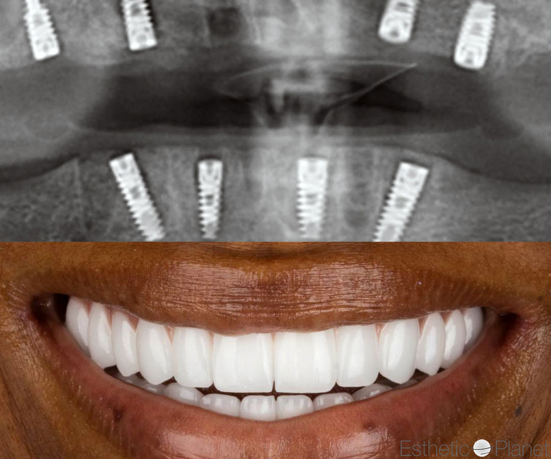 Implants Dentaires — Dentaglobal