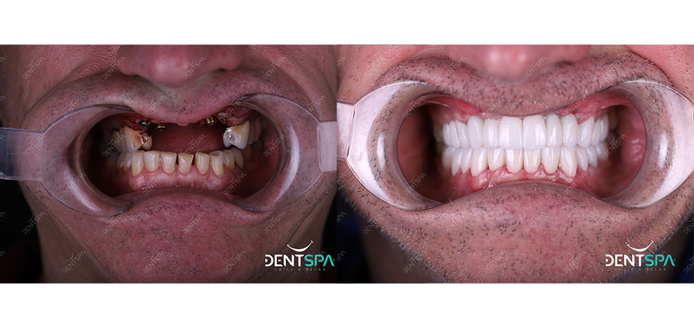 Implants Dentaires — DentSpa Clinic