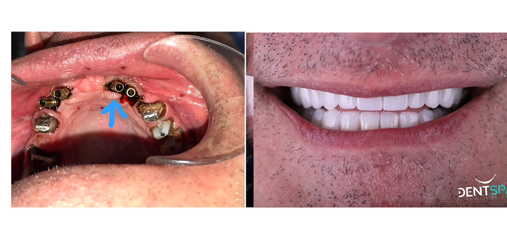Implants Dentaires — DentSpa Clinic