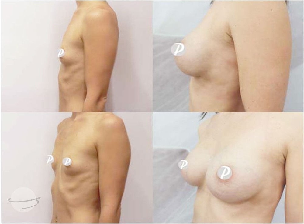Breast Augmentation by Premier Clinic