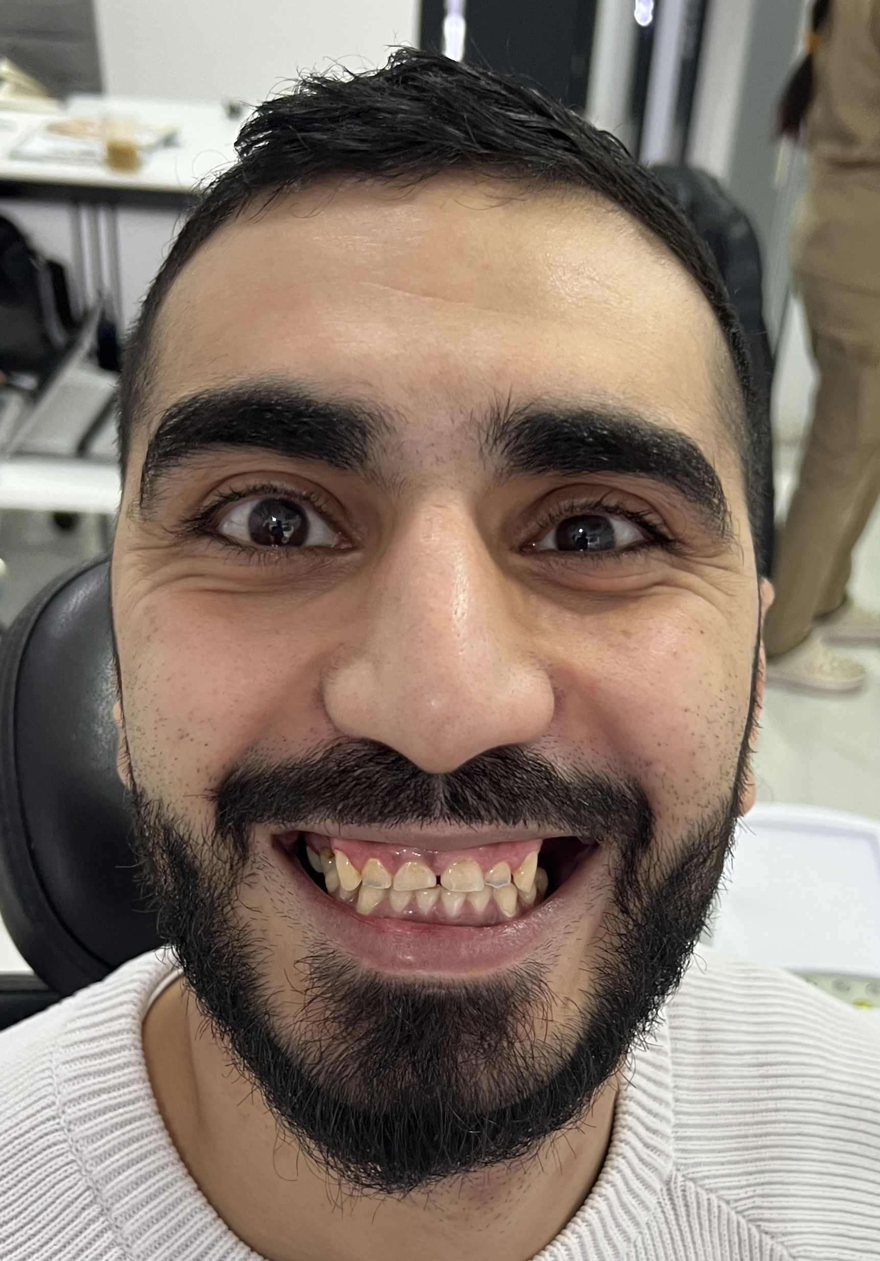 Corone zirconio — Dentglow