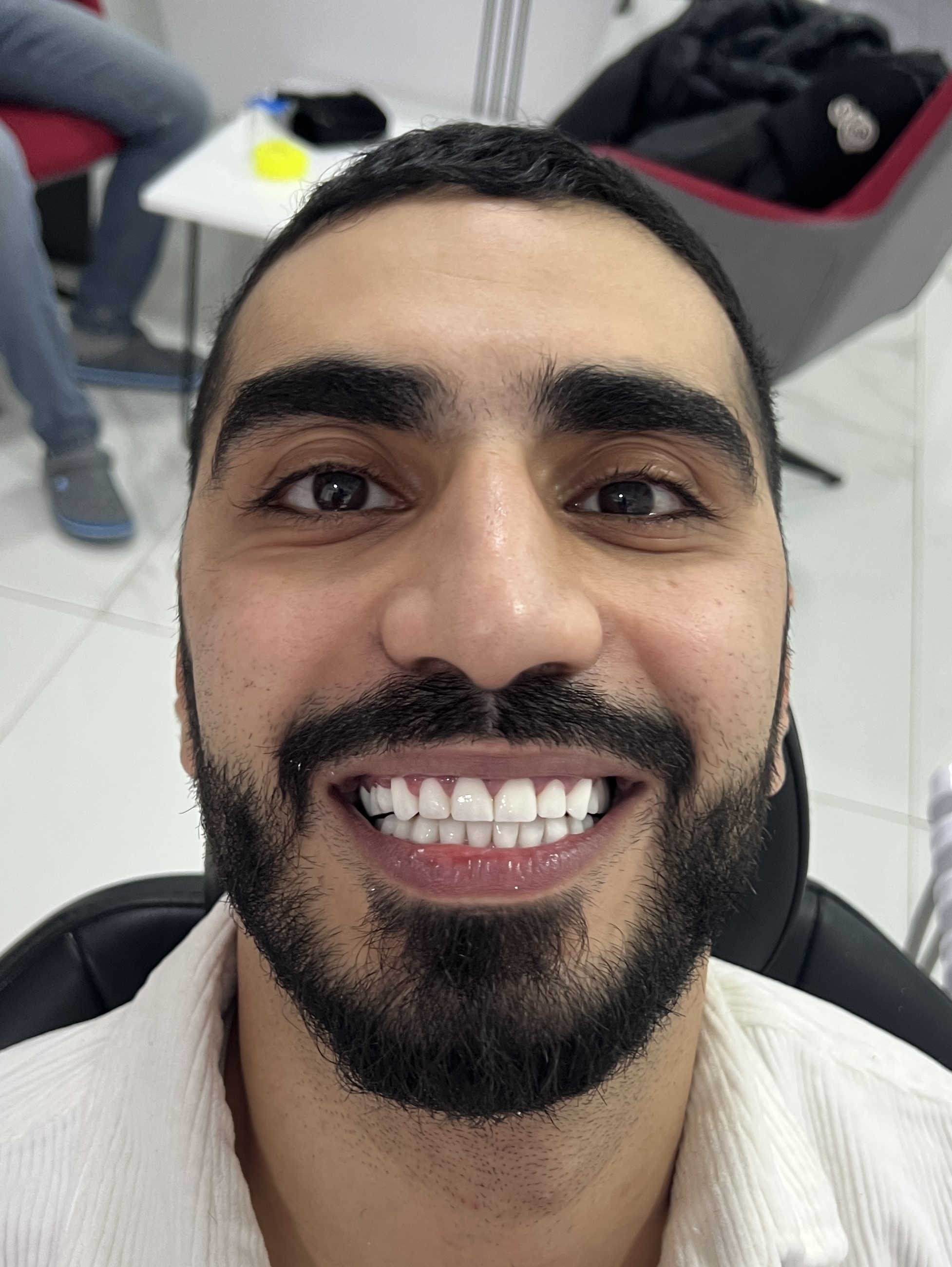 Corone zirconio — Dentglow