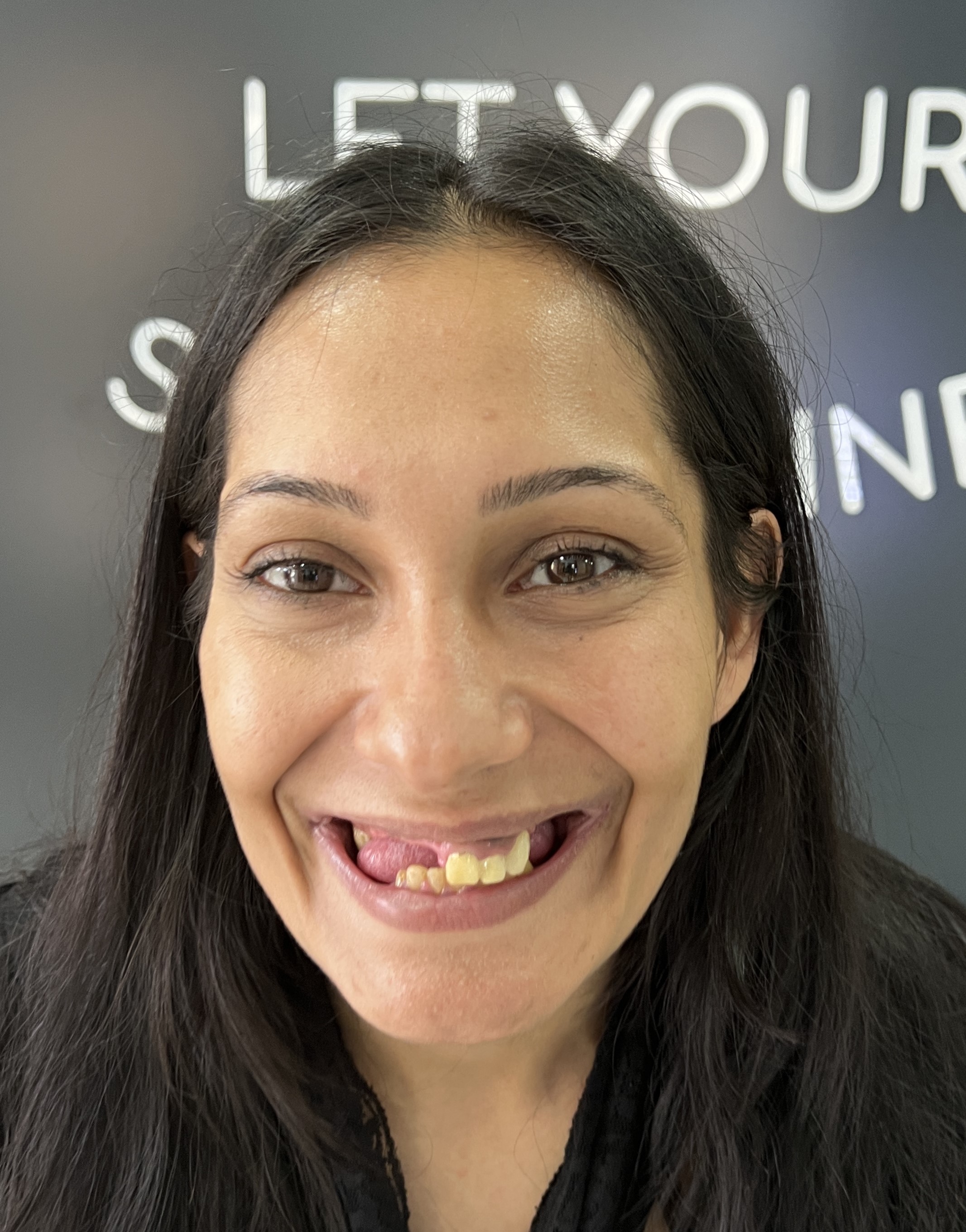 Corone zirconio — Dentglow