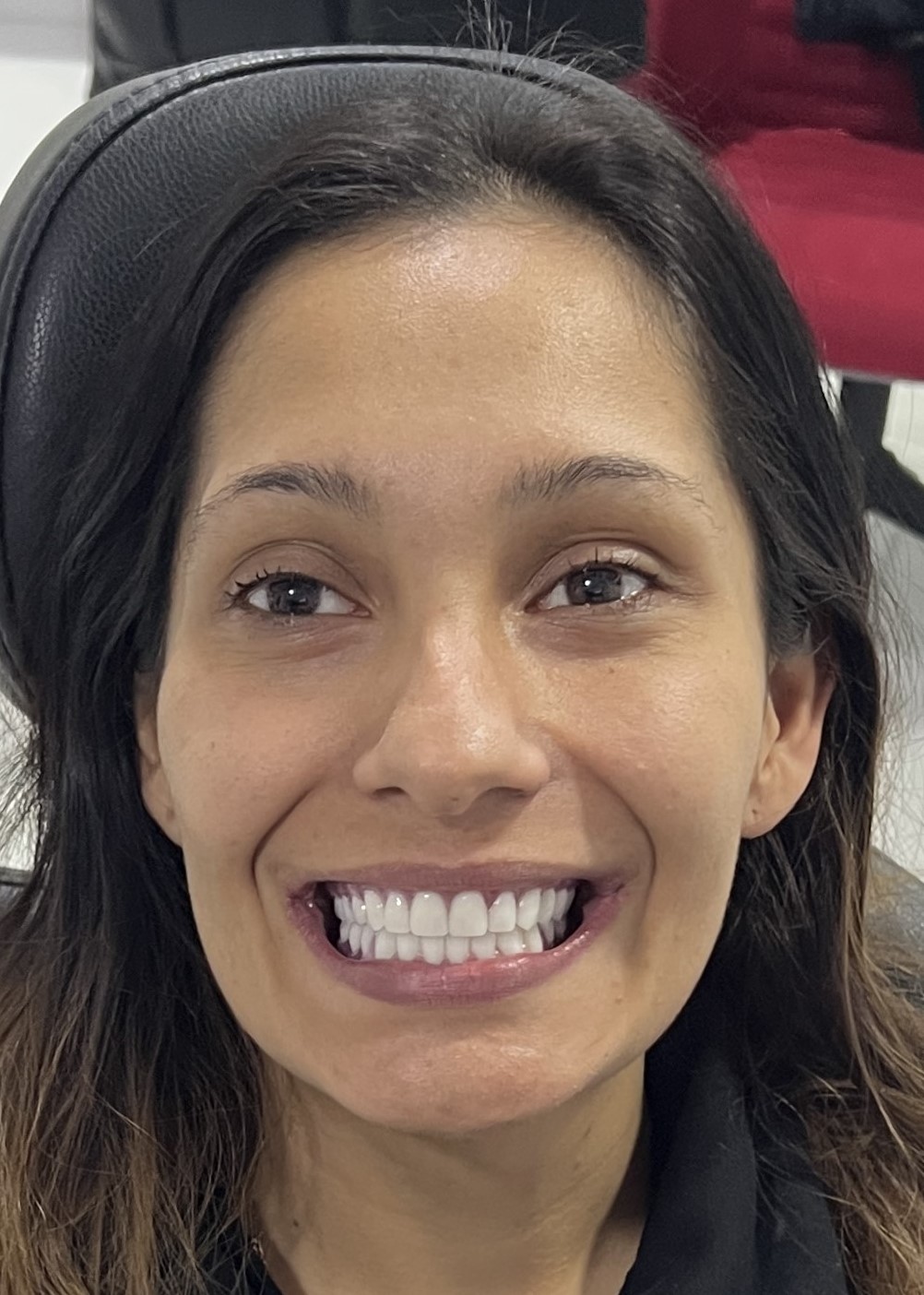 Corone zirconio — Dentglow