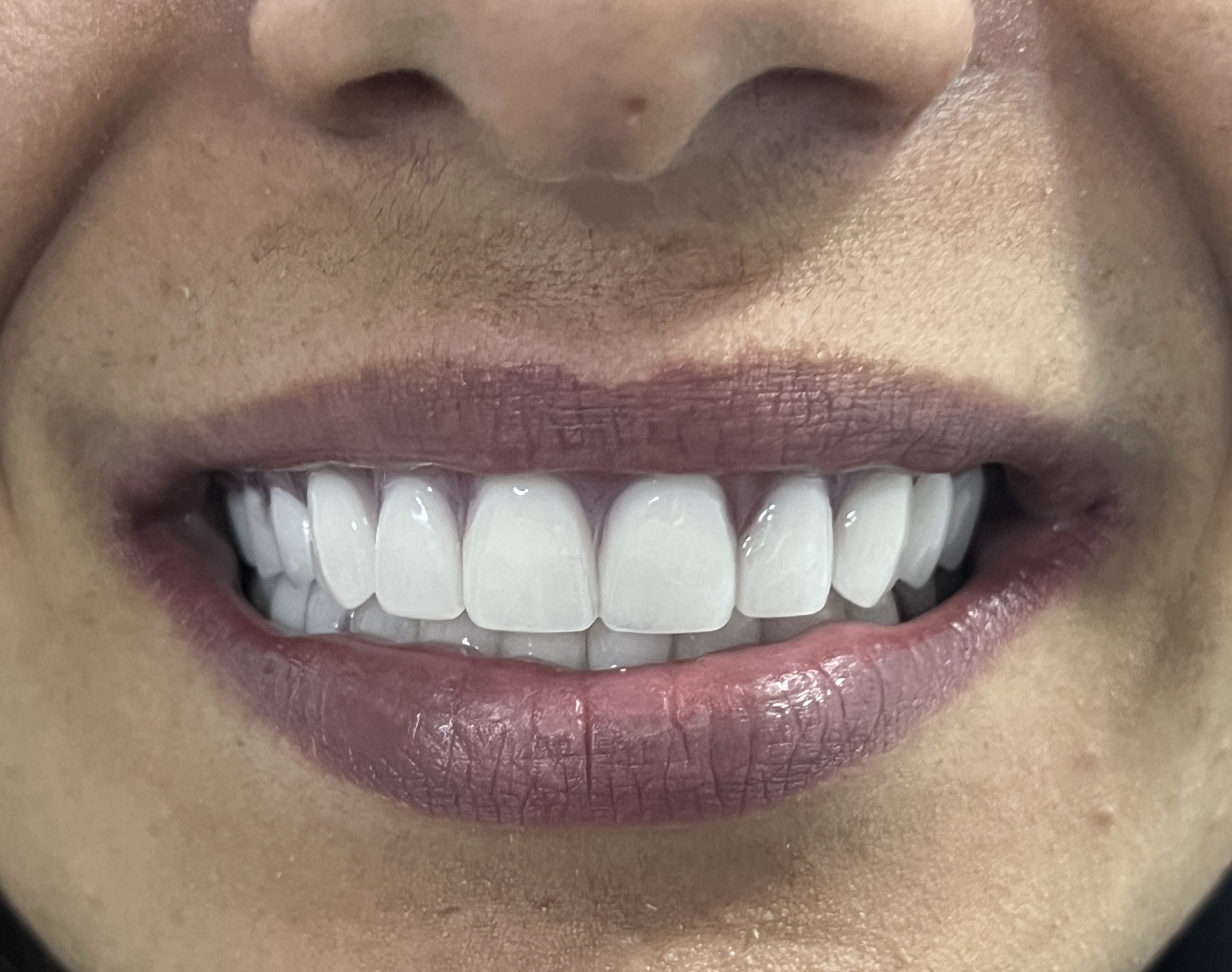 Corone zirconio — Dentglow