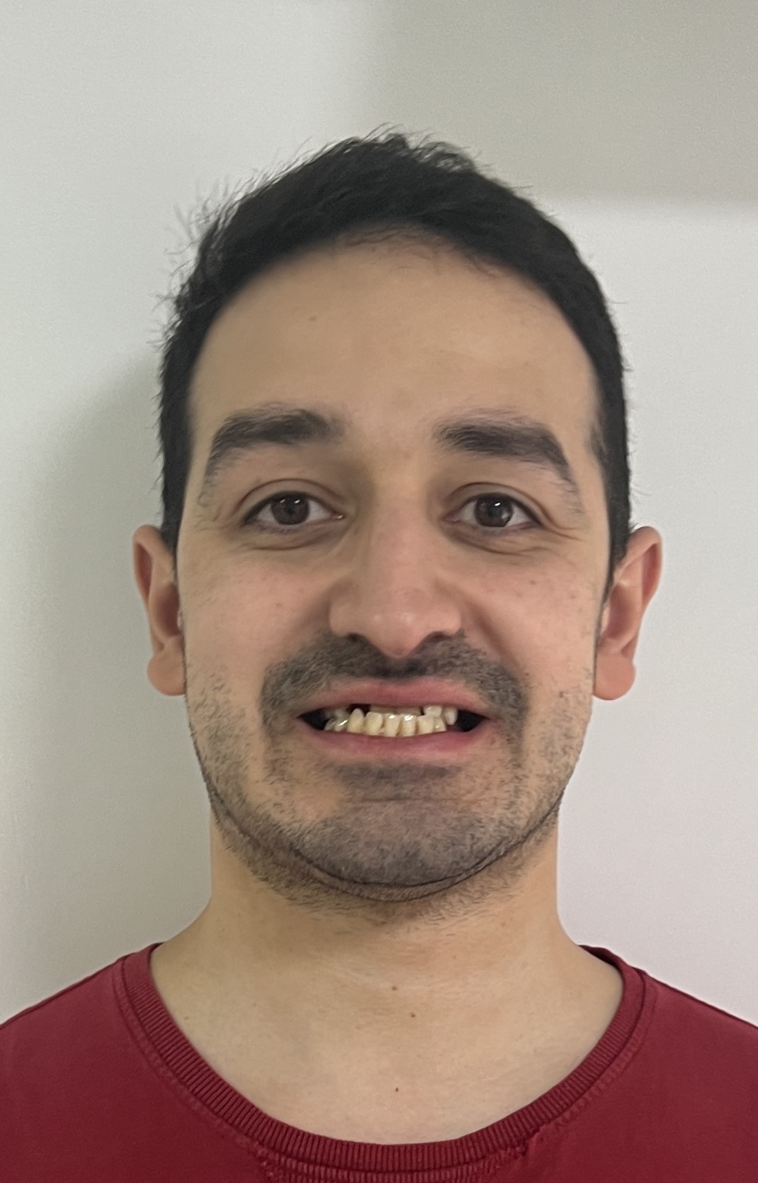 Corone zirconio — Dentglow