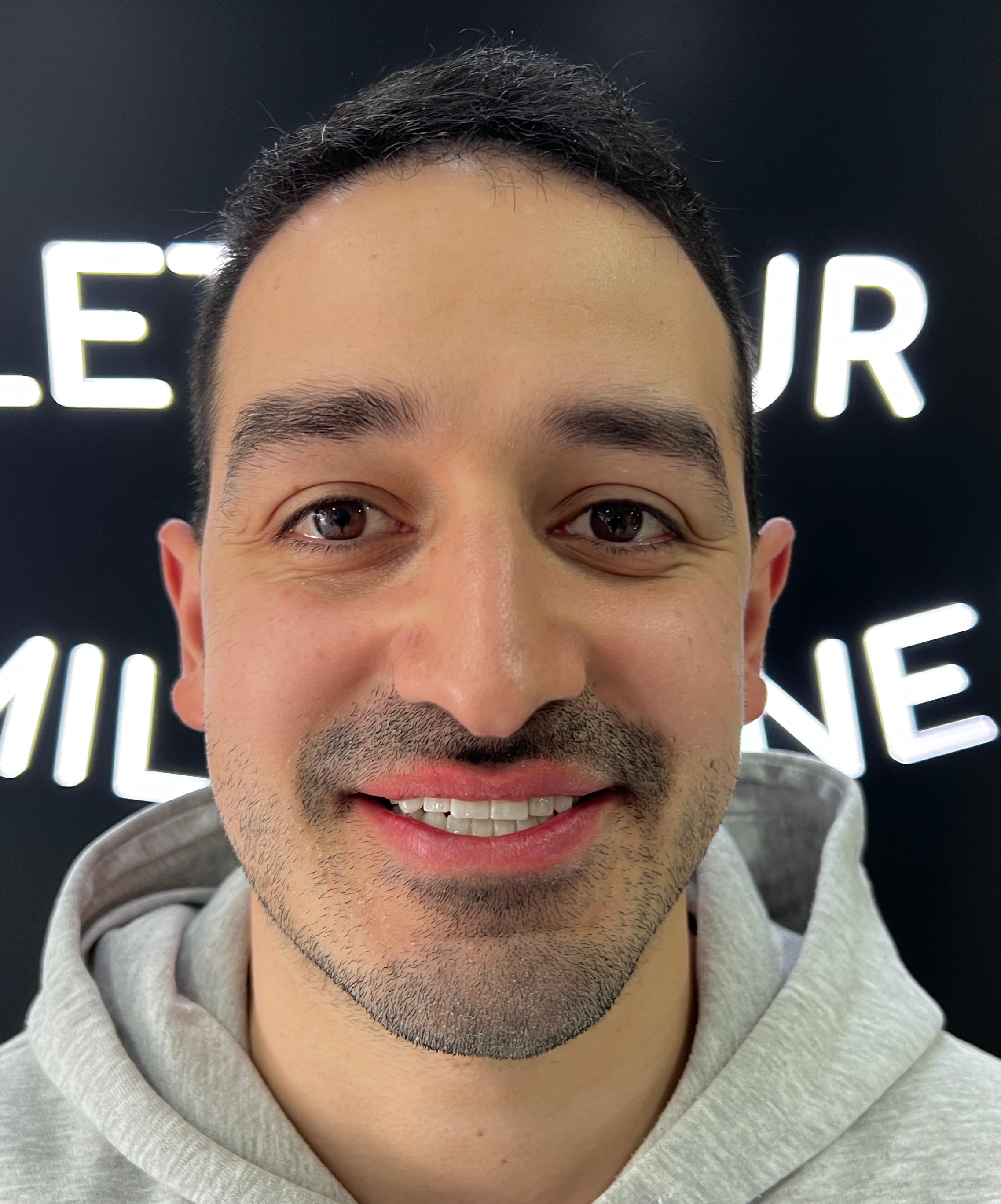 Corone zirconio — Dentglow