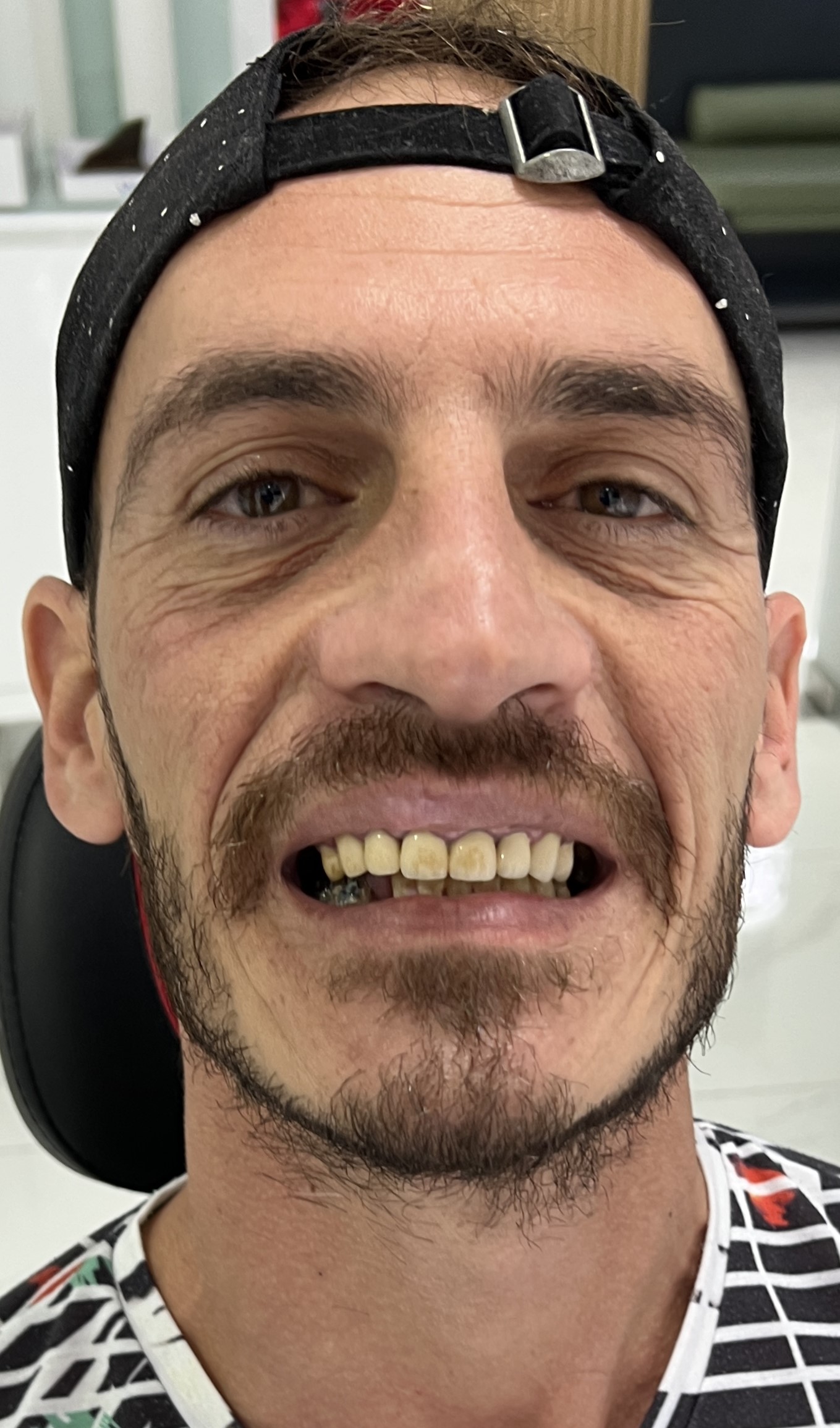 Corone zirconio — Dentglow