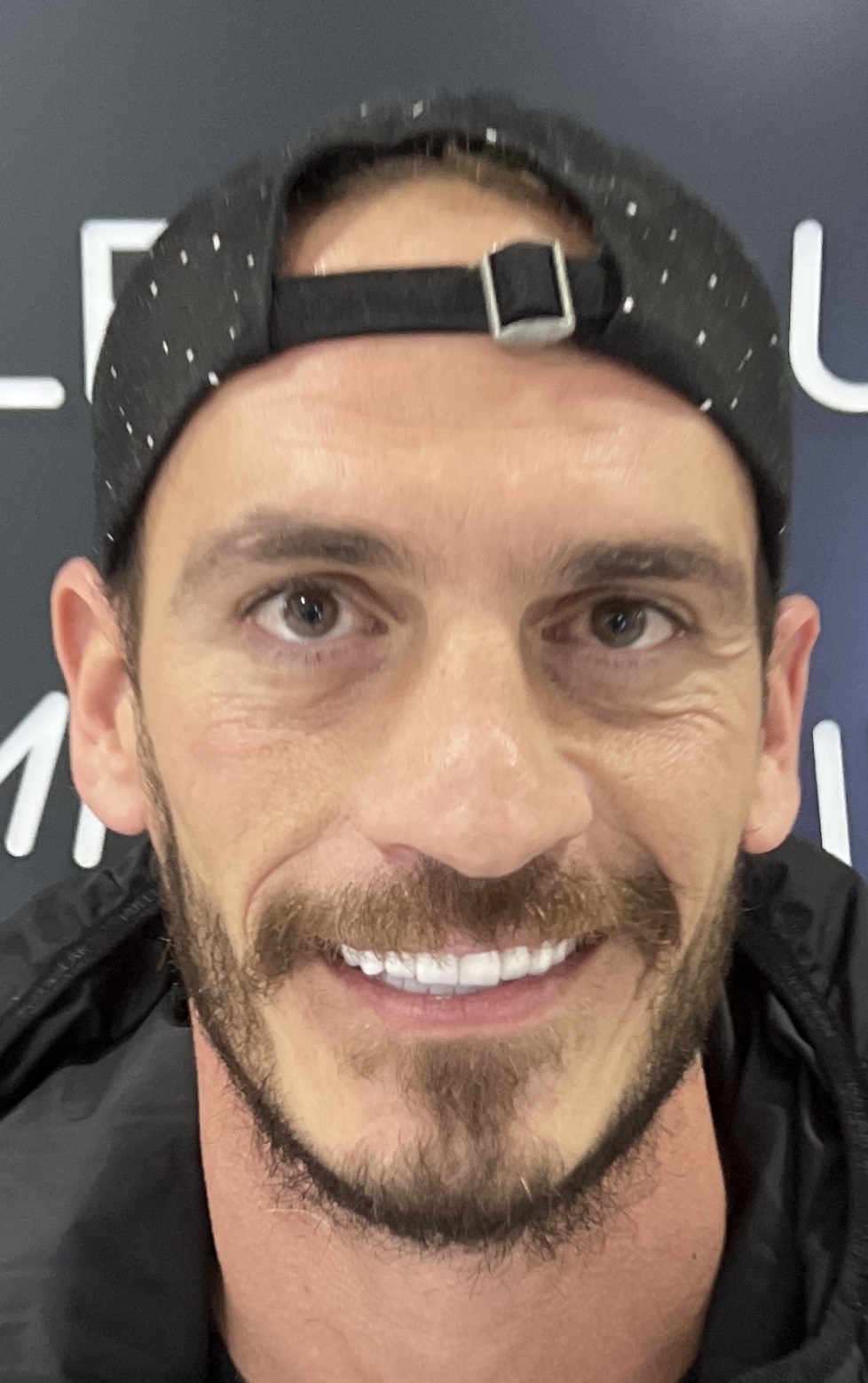 Corone zirconio — Dentglow