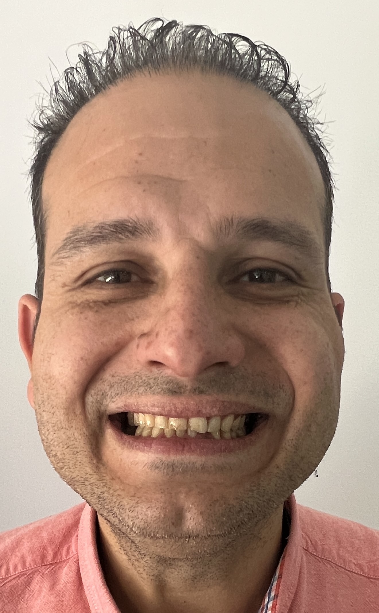 Corone zirconio — Dentglow