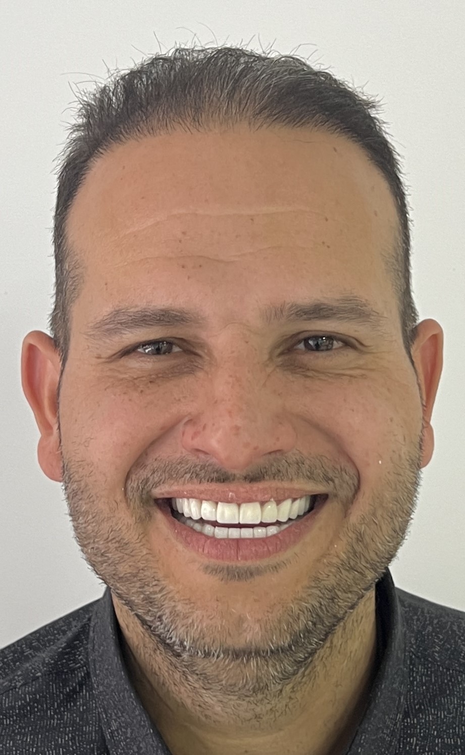 Corone zirconio — Dentglow