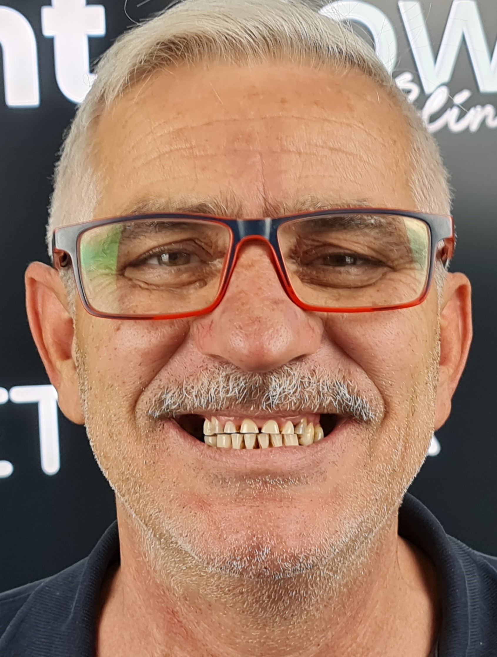 Corone zirconio — Dentglow