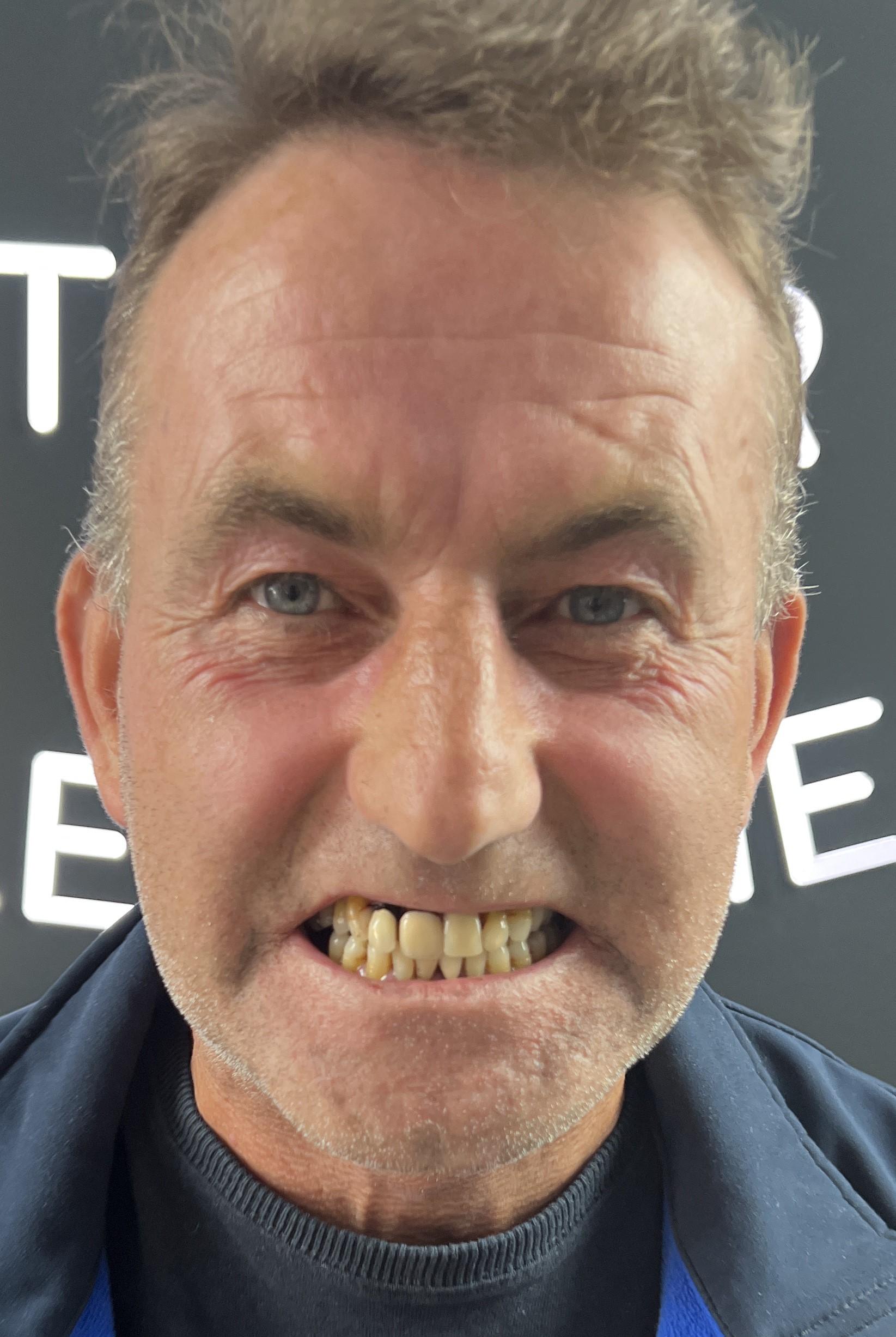 Corone zirconio — Dentglow