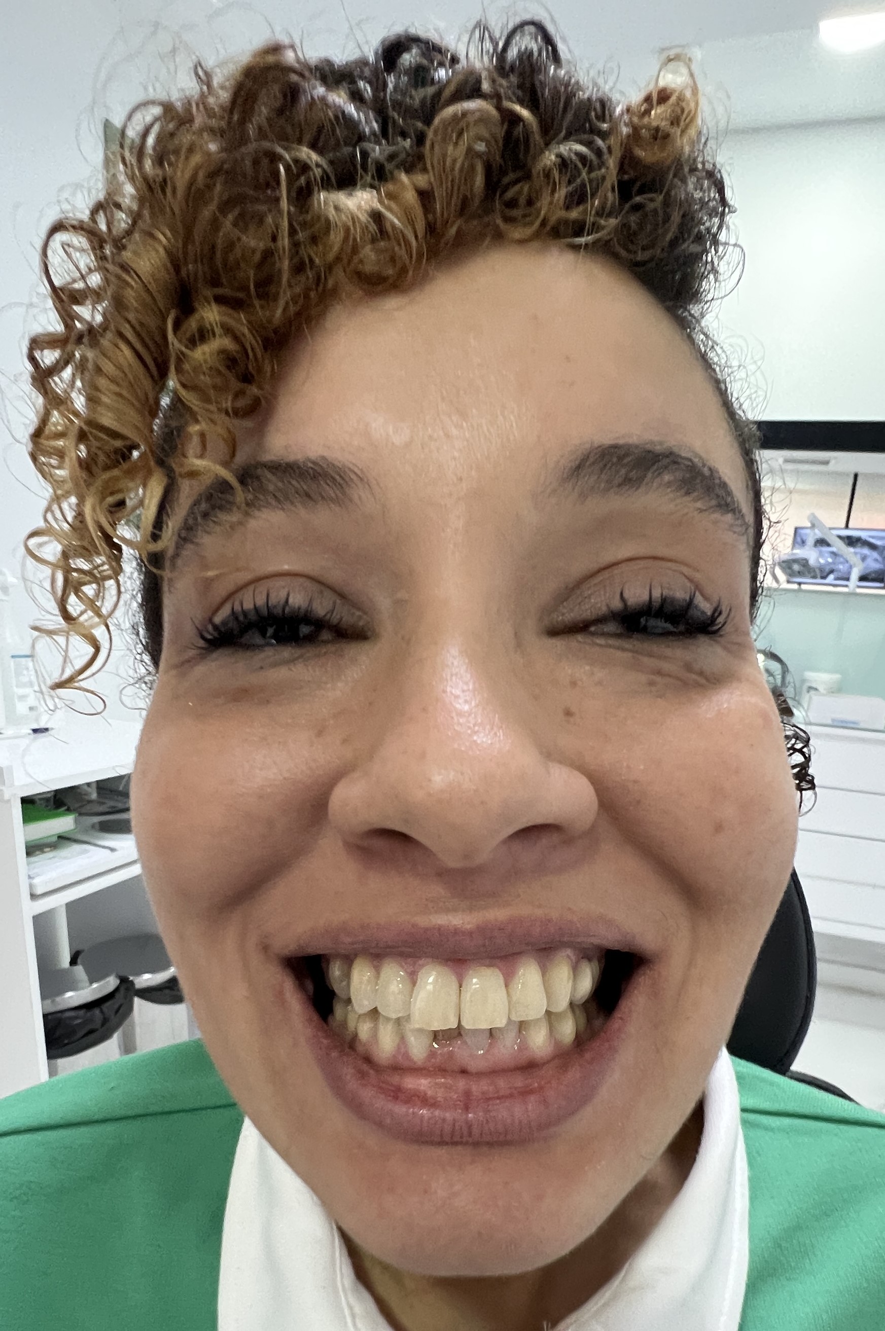 Corone zirconio — Dentglow