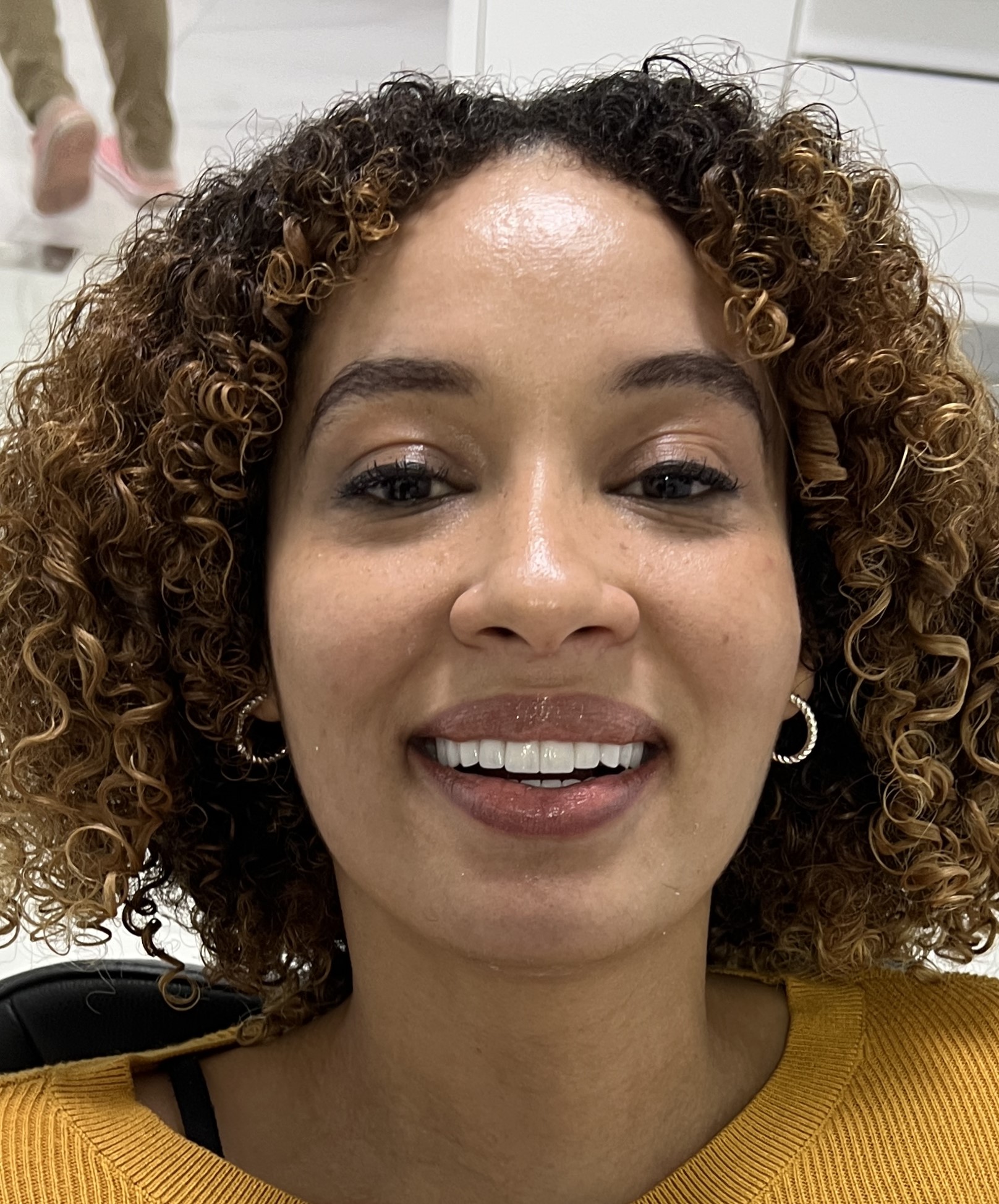 Corone zirconio — Dentglow