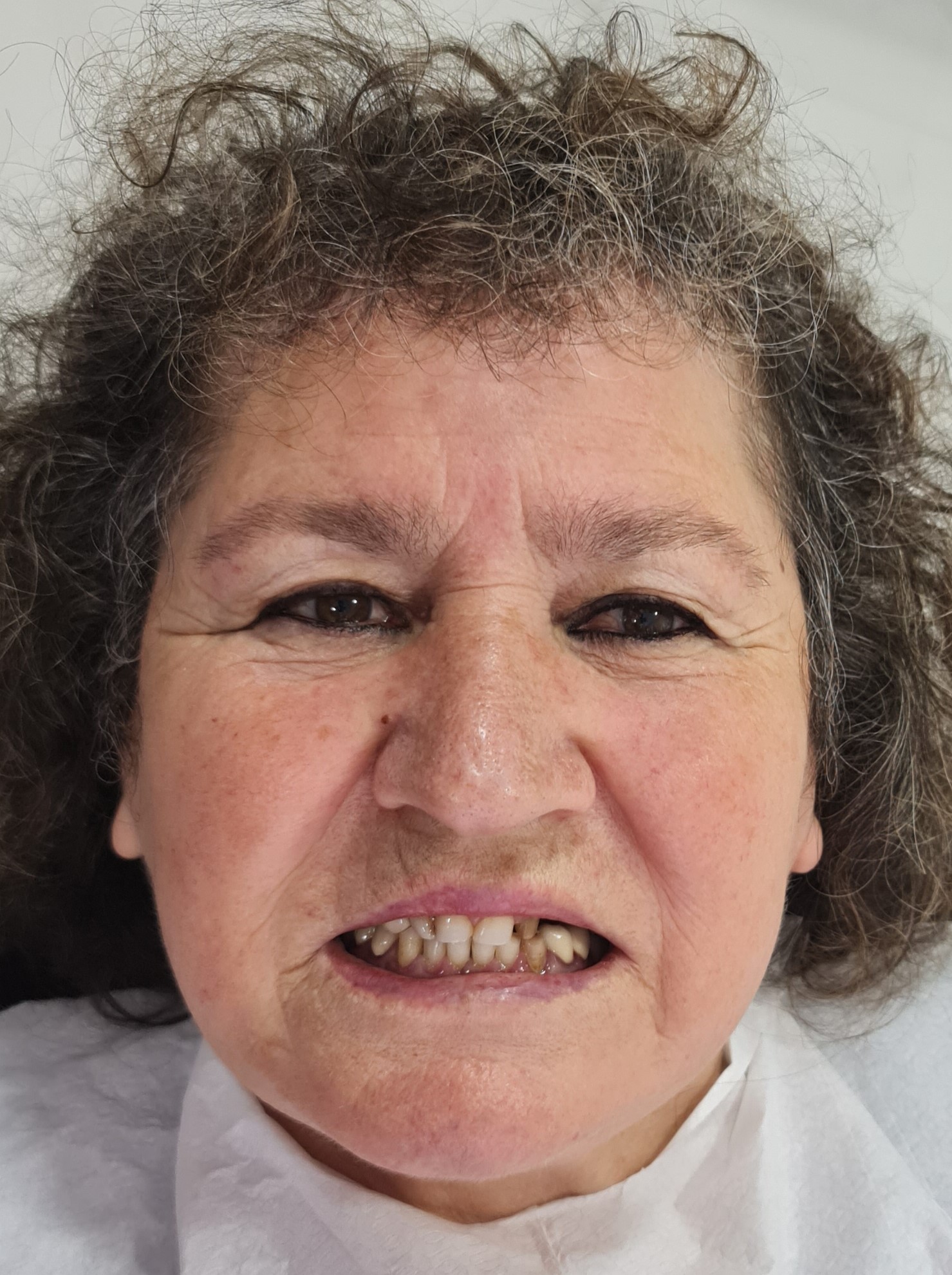 Corone zirconio — Dentglow