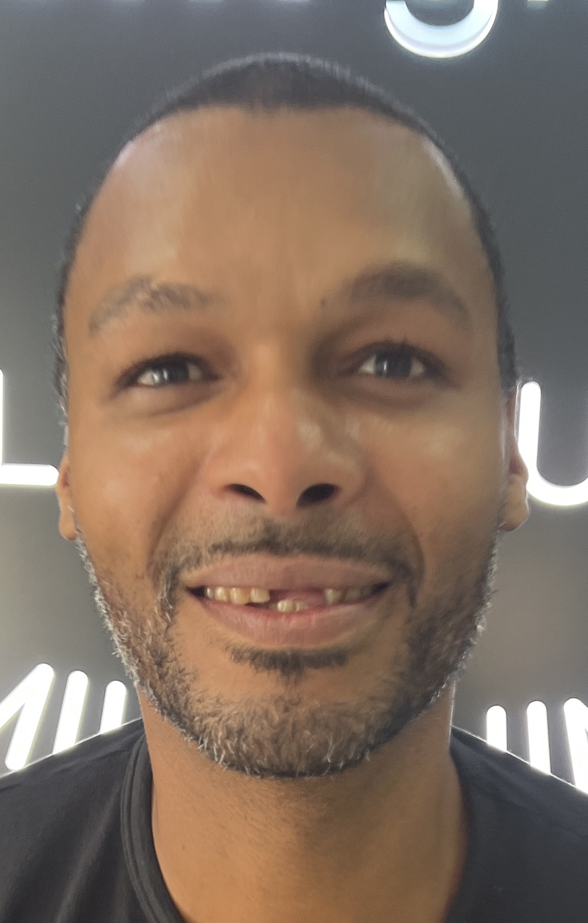 Corone zirconio — Dentglow