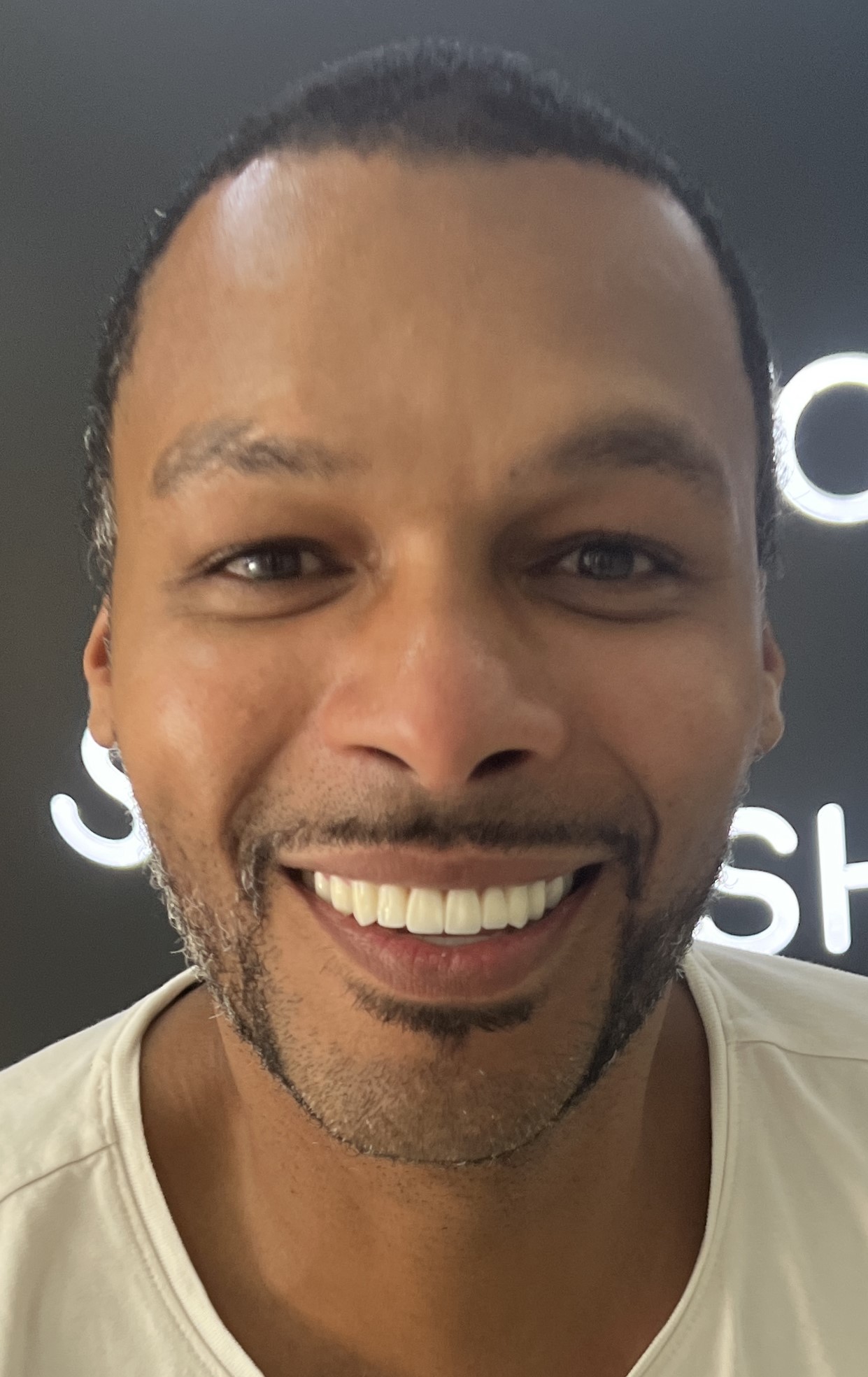 Corone zirconio — Dentglow