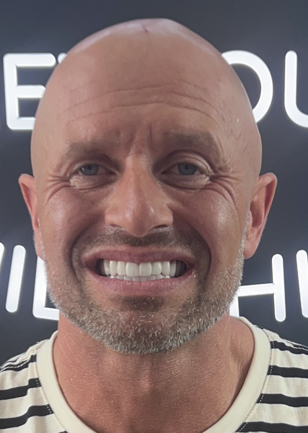 Corone zirconio — Dentglow