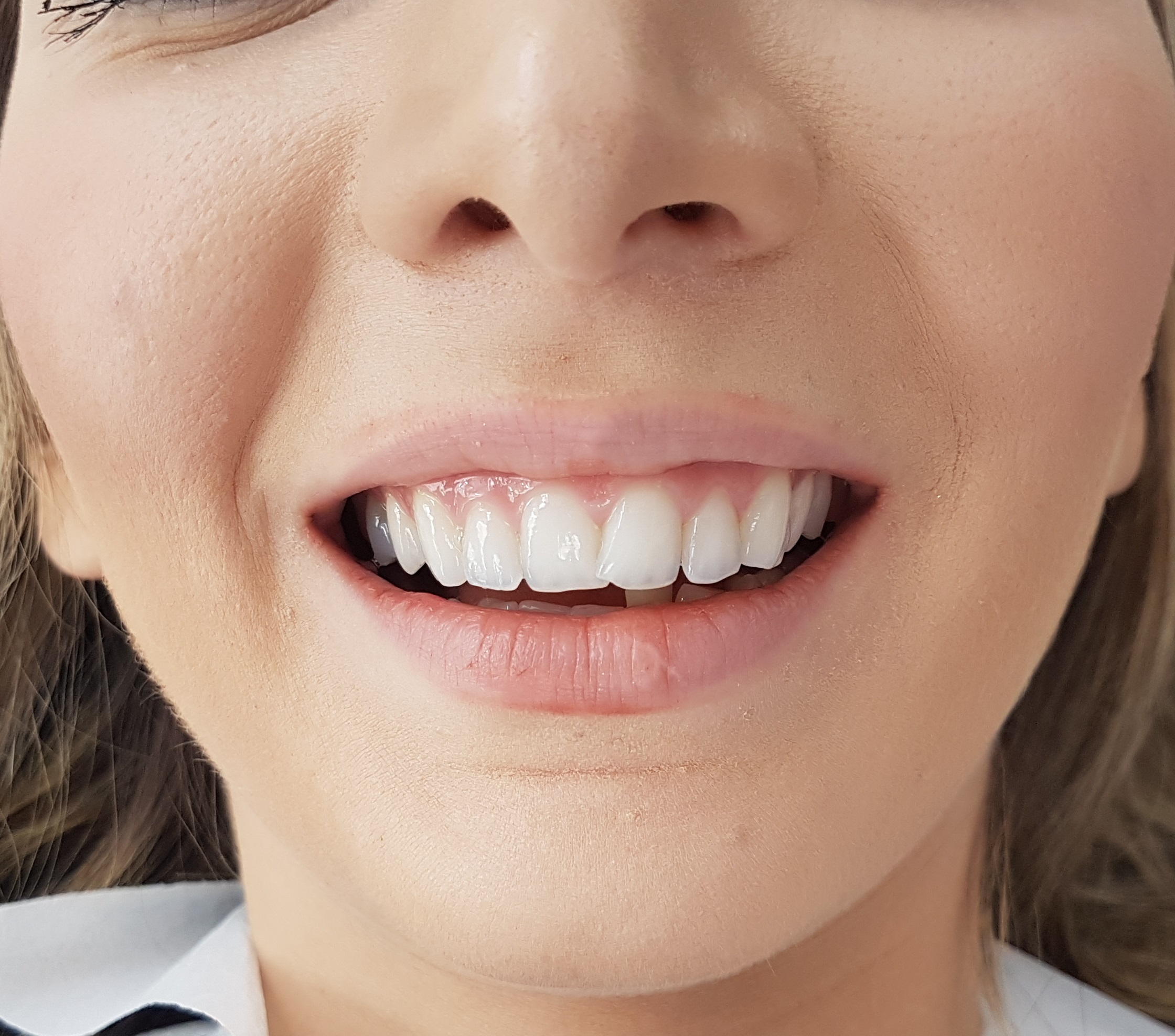 Facettes Emax — Dentglow