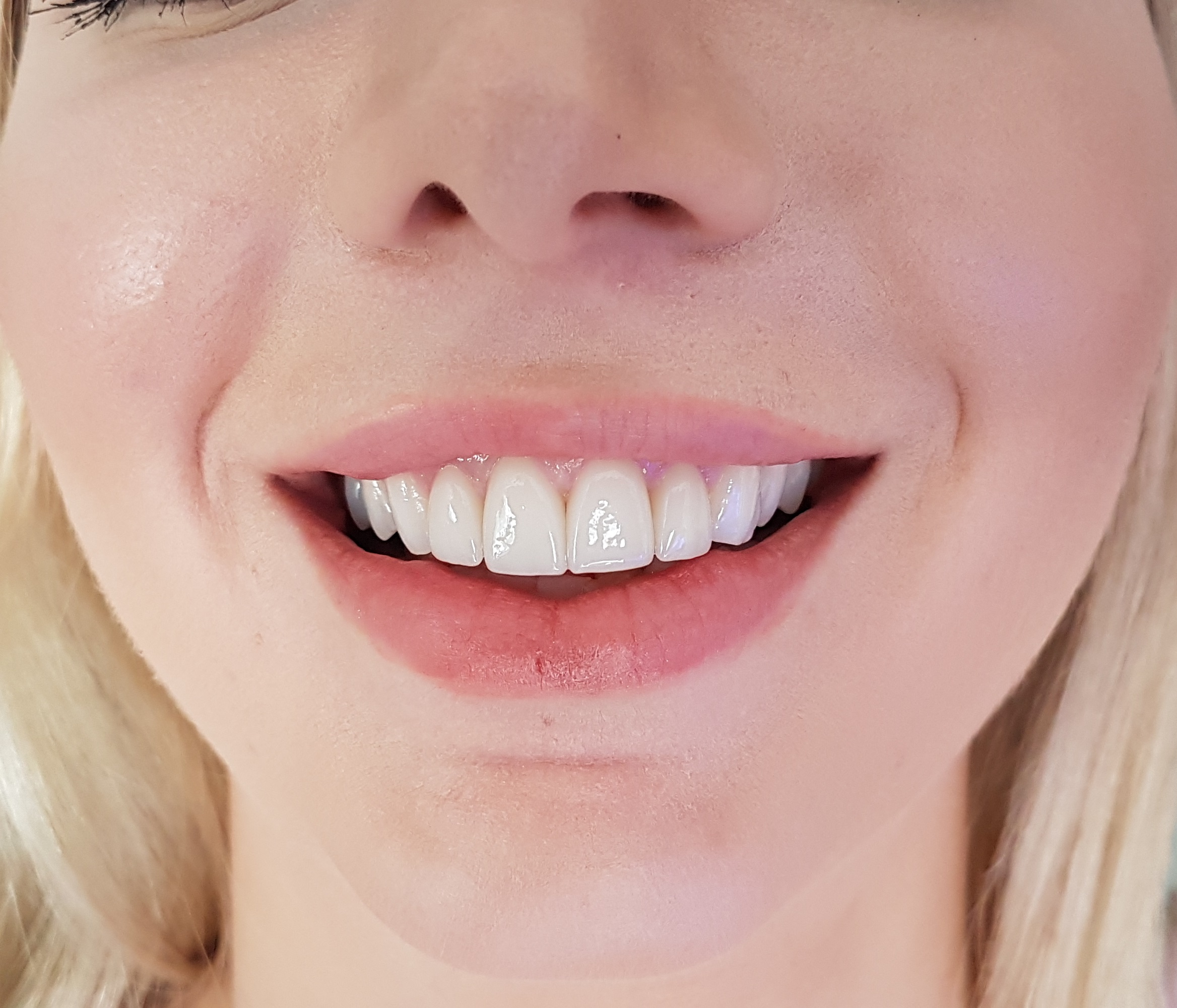 Facettes Emax — Dentglow