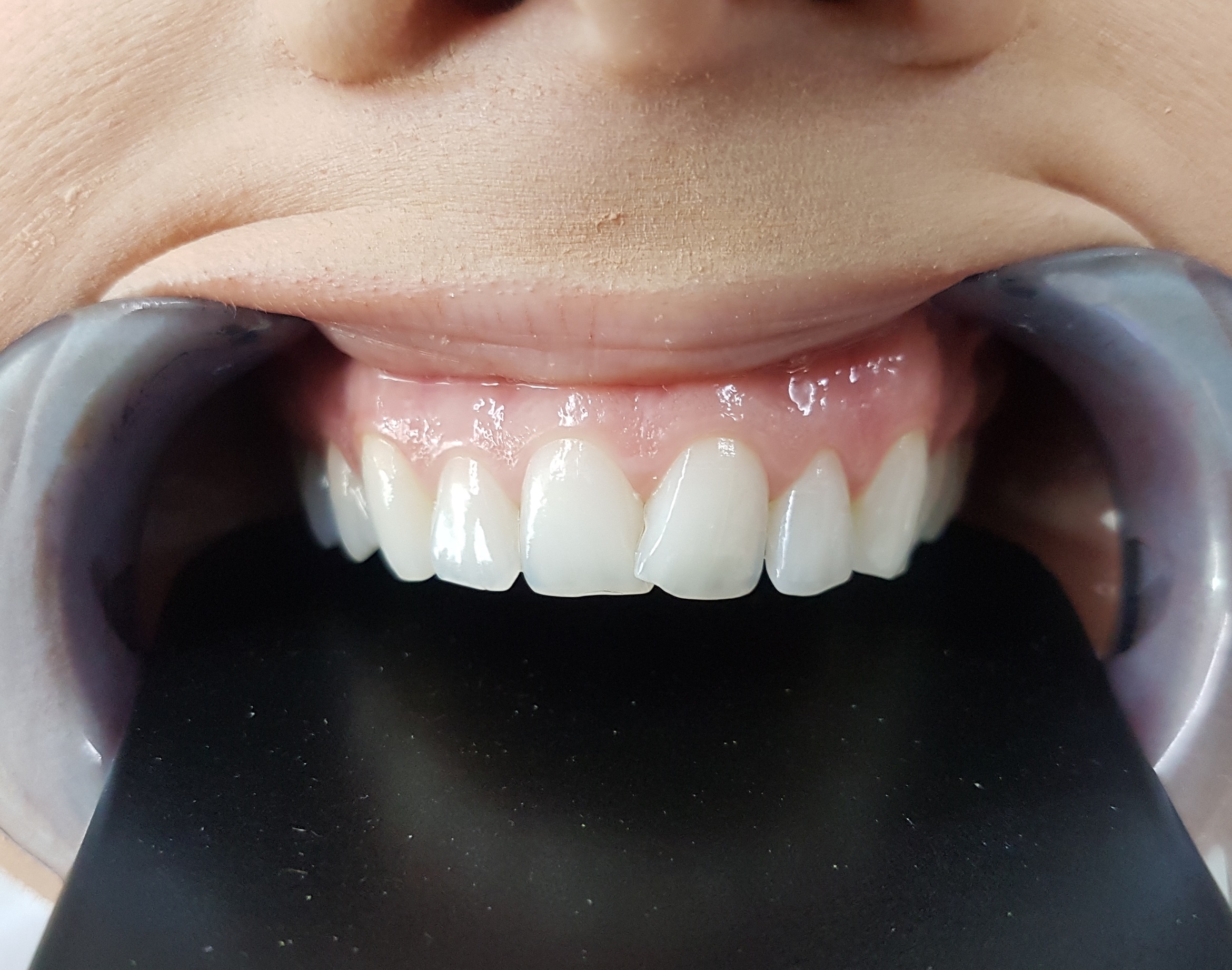 Facettes Emax — Dentglow