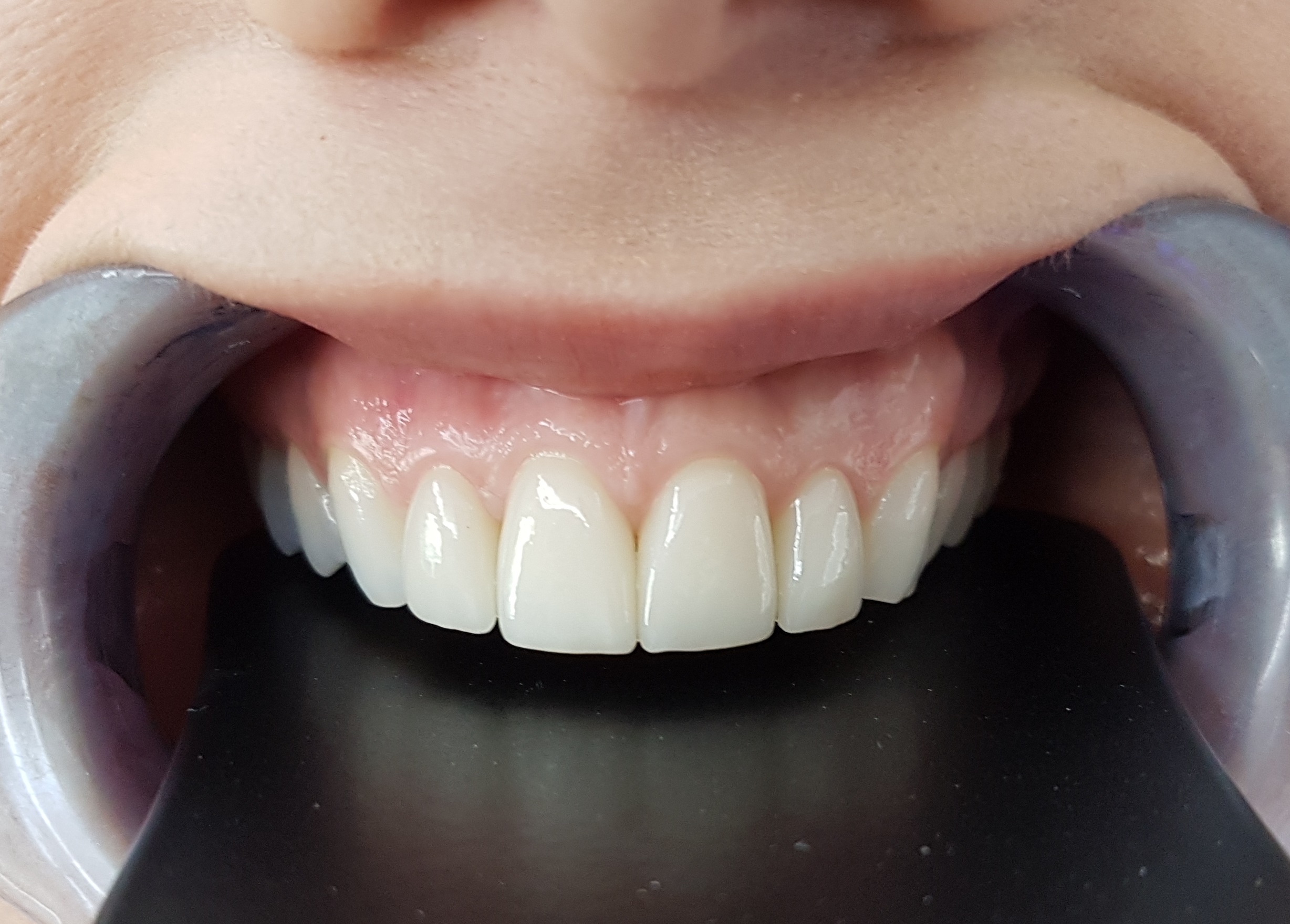 Facettes Emax — Dentglow