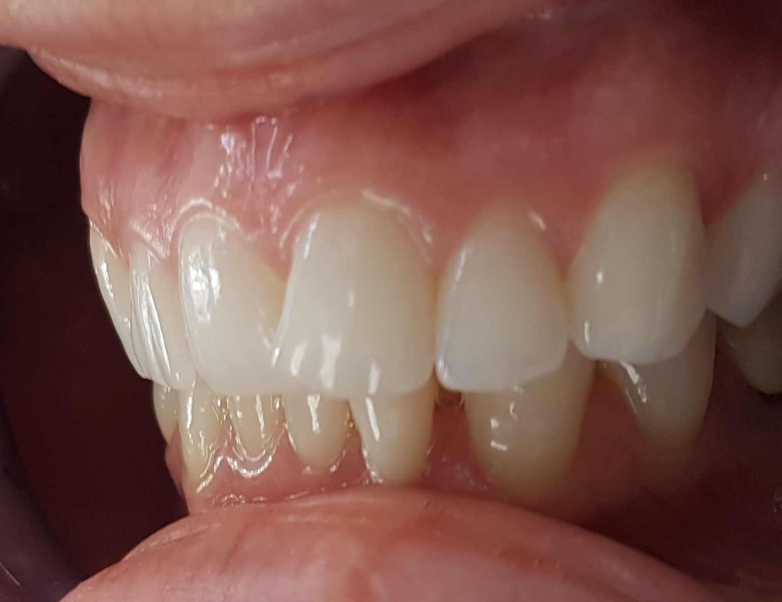 Facettes Emax — Dentglow