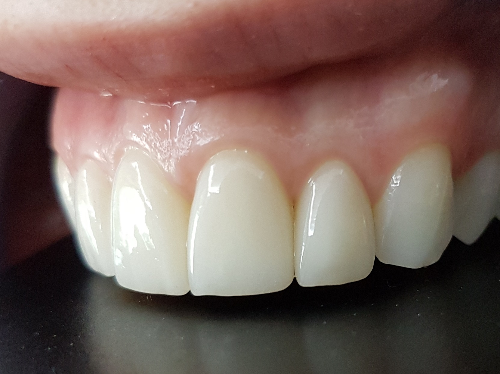 Facettes Emax — Dentglow