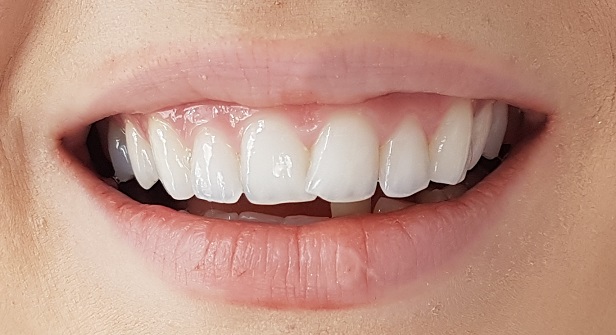Facettes Emax — Dentglow