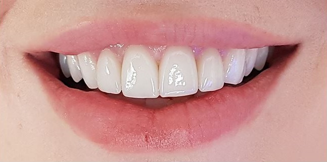 Facettes Emax — Dentglow