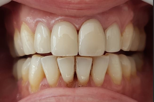 Facettes Emax — Dentglow