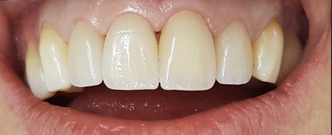 Facettes Emax — Dentglow