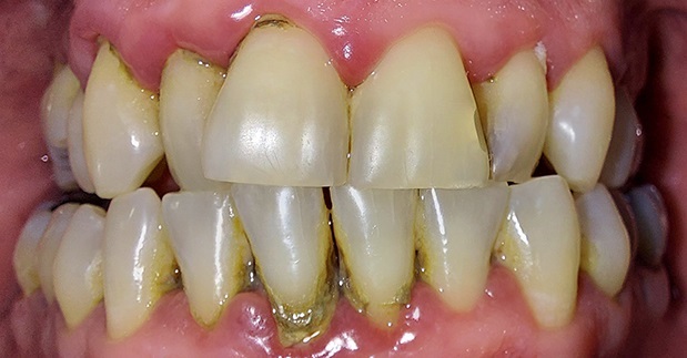 Facettes Emax — Dentglow