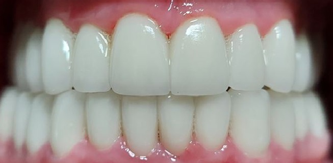 Facettes Emax — Dentglow