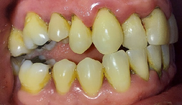 Facettes Emax — Dentglow