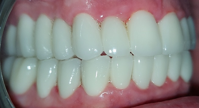 Facettes Emax — Dentglow