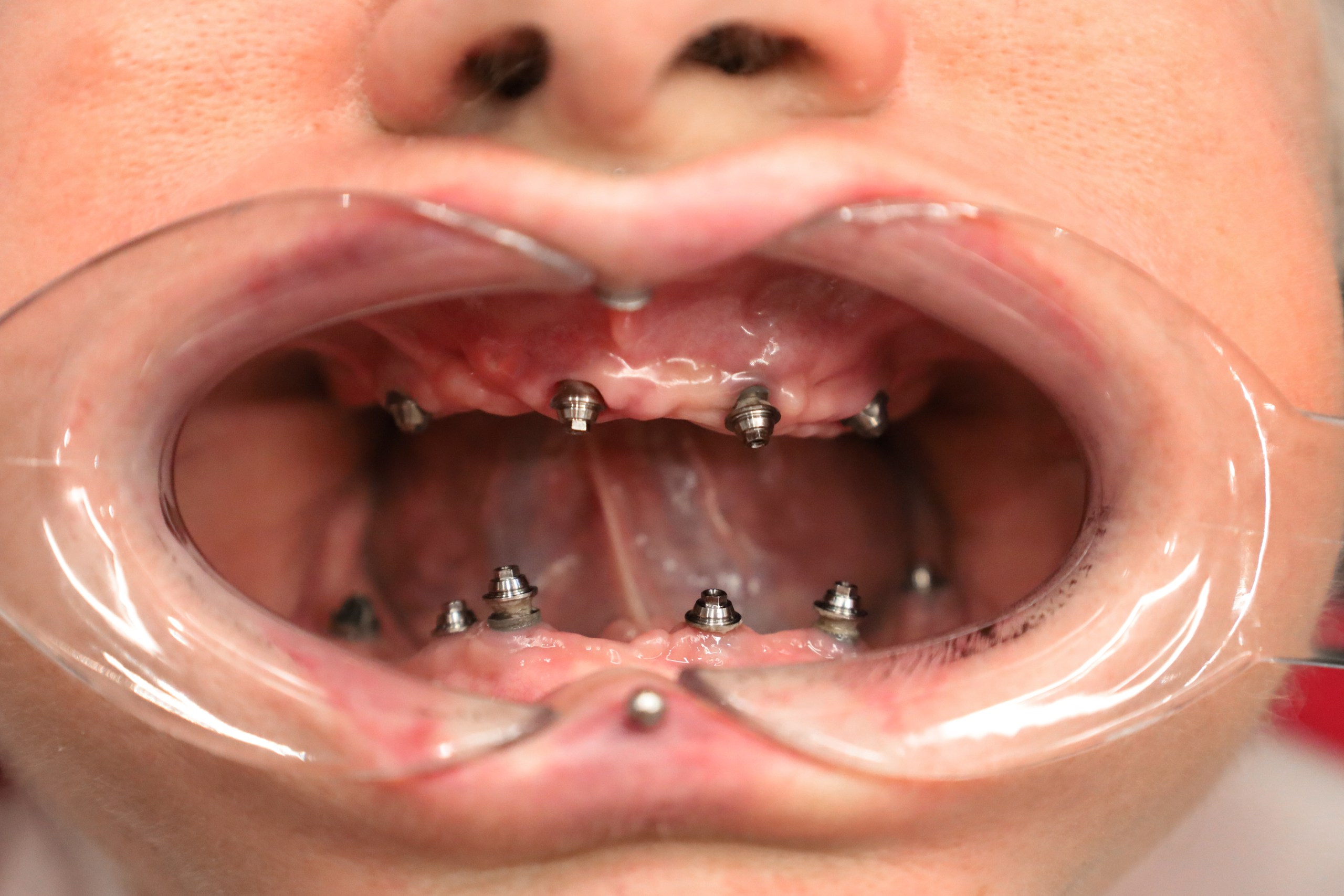 Implants Straumann — WestDent Clinic