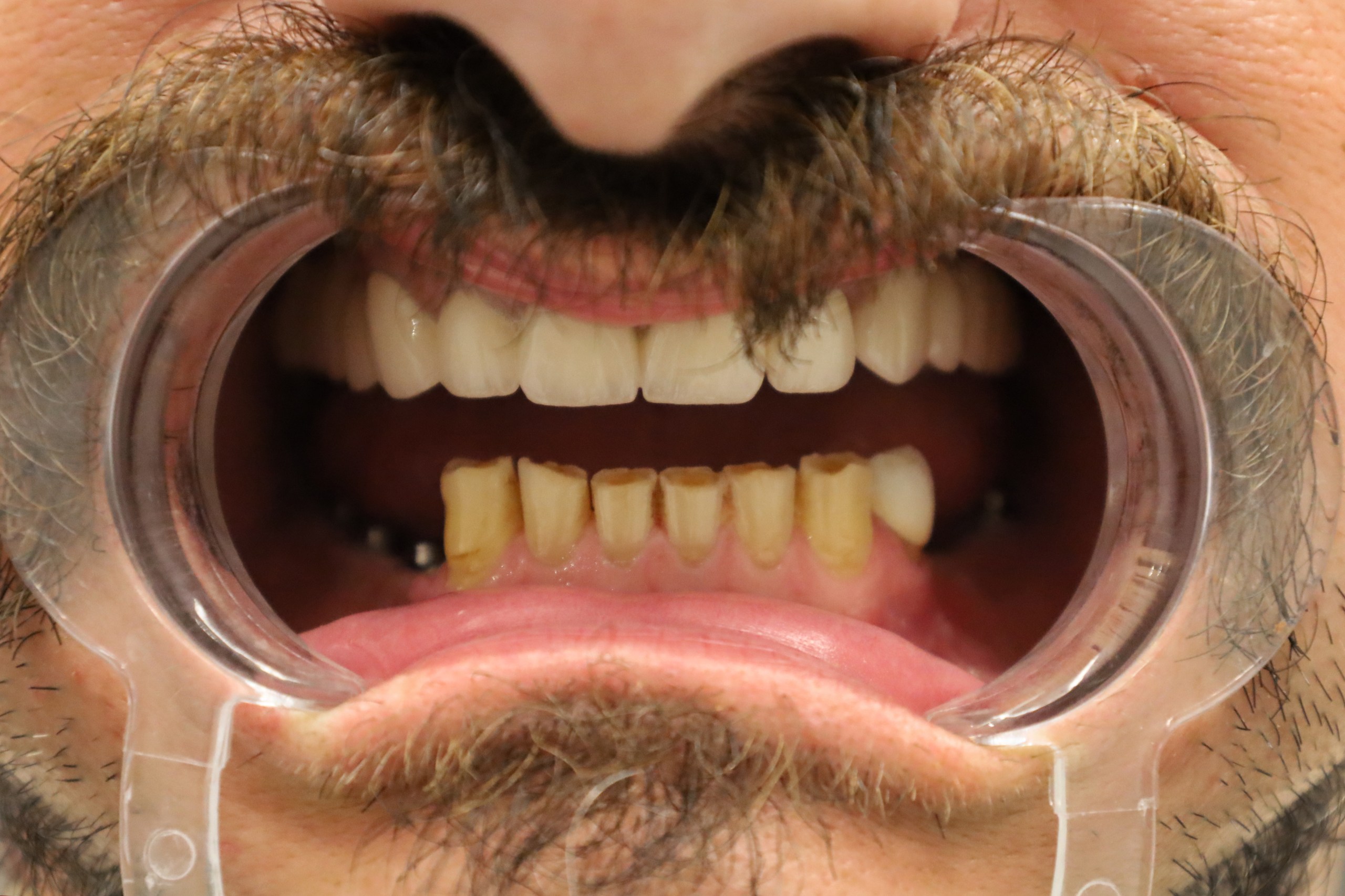 Implants Straumann — WestDent Clinic