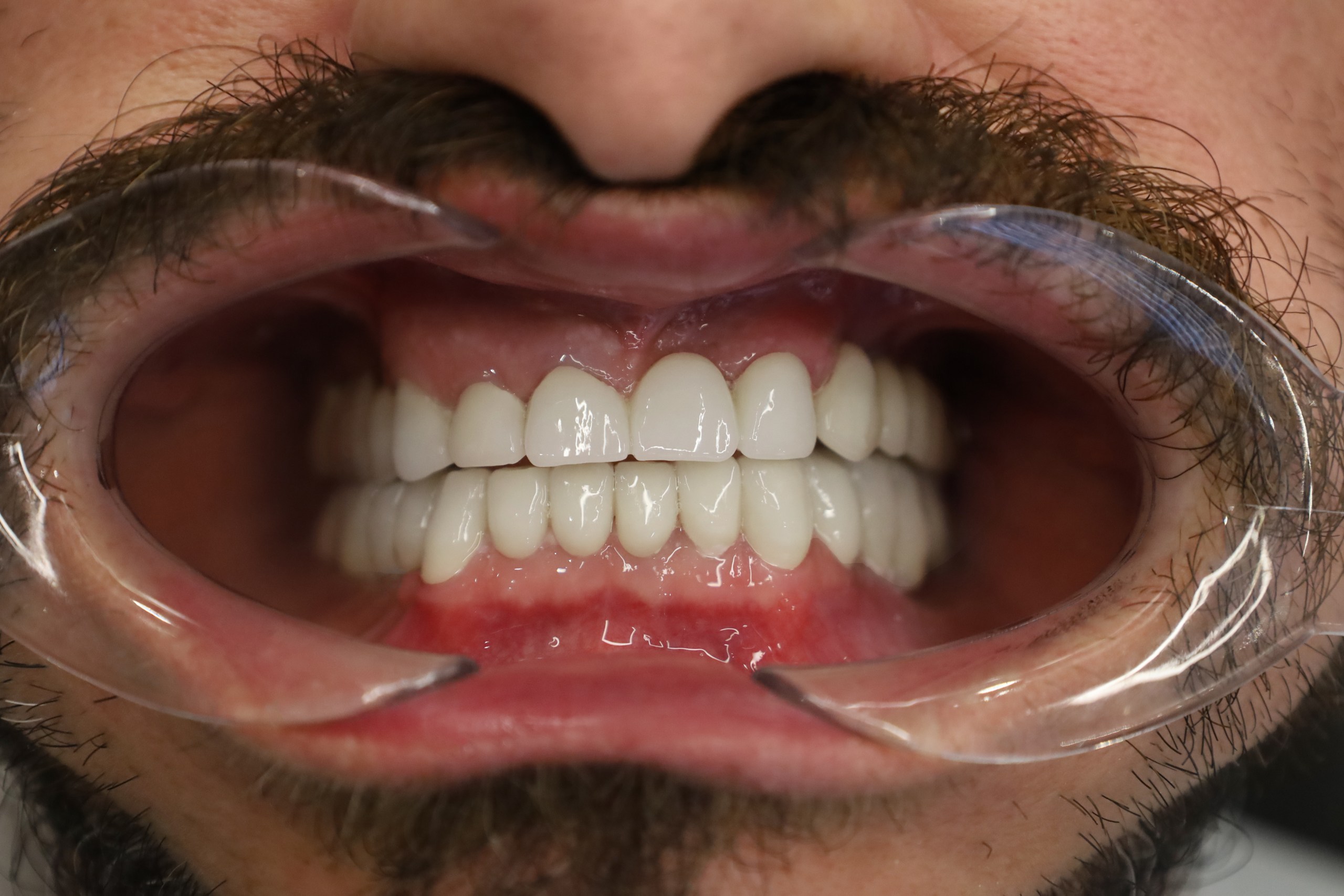 Implants Straumann — WestDent Clinic