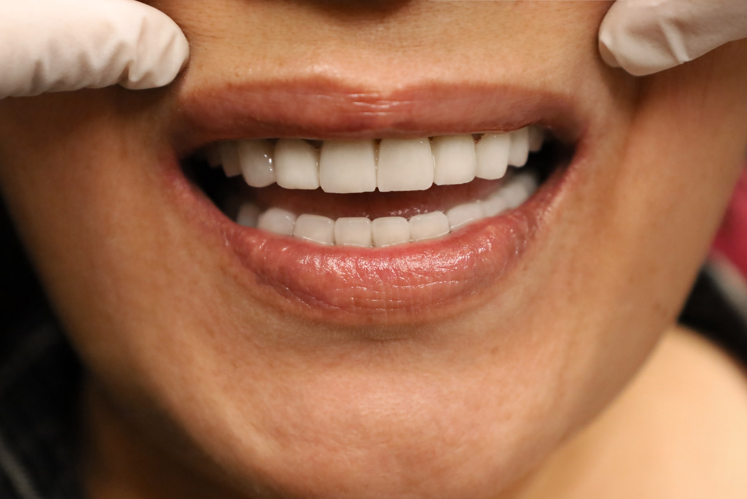 Corone zirconio — WestDent Clinic